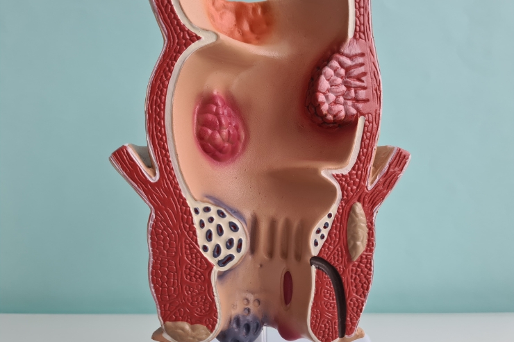 Piles, Fissures, and Fistula Treatment
