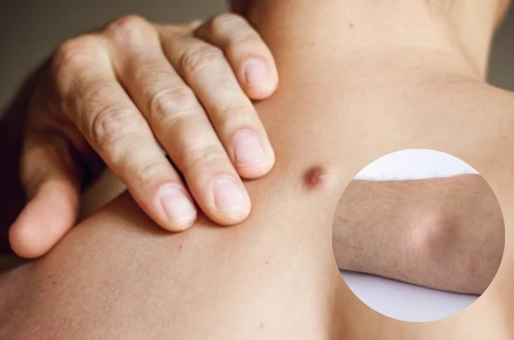 Leucorrhea, Cysts & Tumors